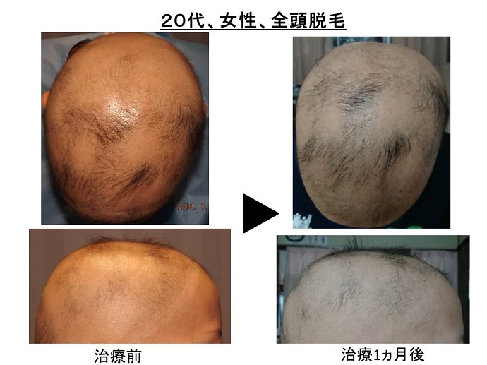 円形脱毛症　病院